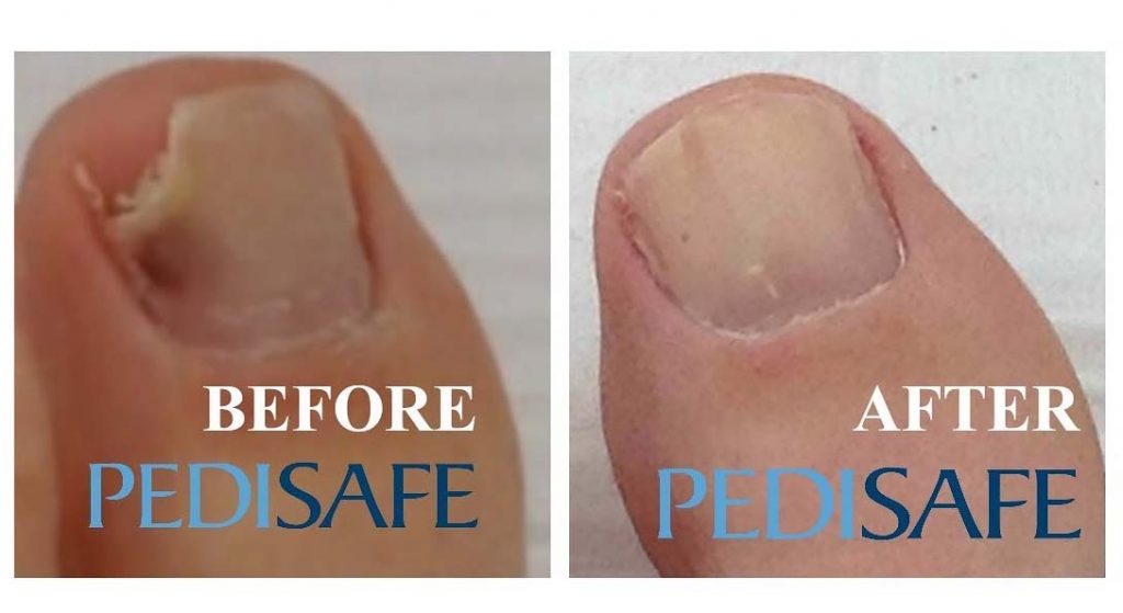 Pedisafe